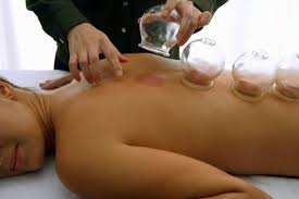 Acupuncture et ventouses chinoises à Paris